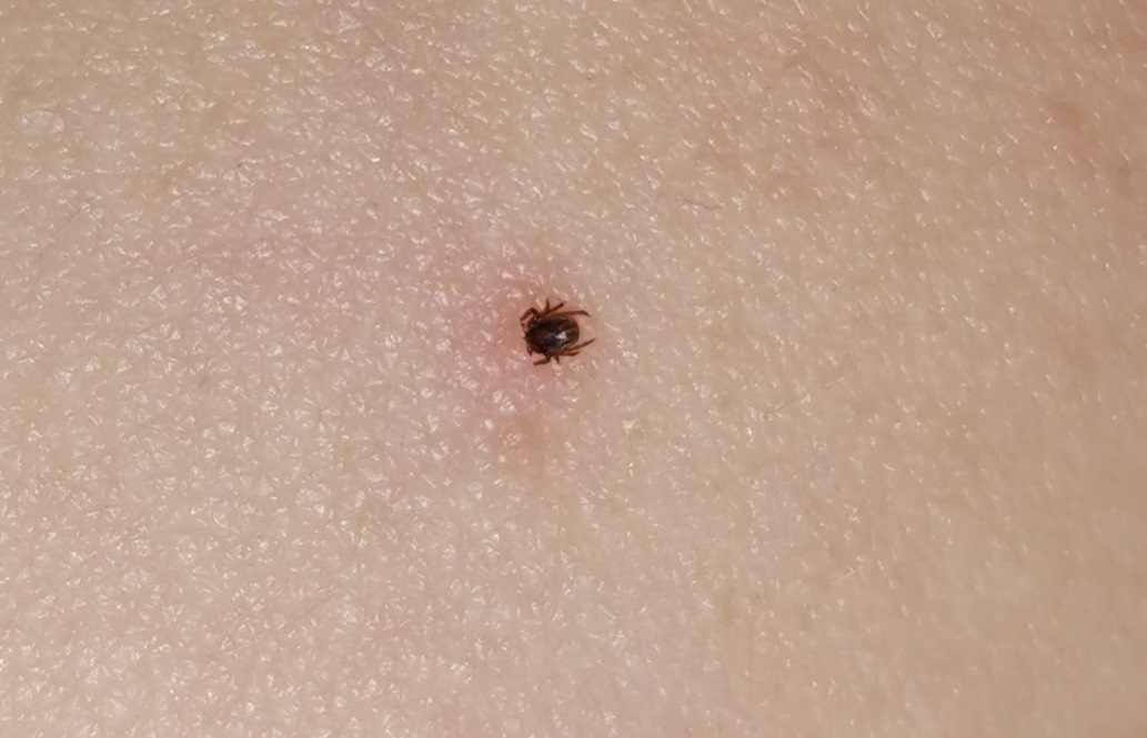 Encefalite da zecca: Andrea Zanotelli non ce l'ha fatta